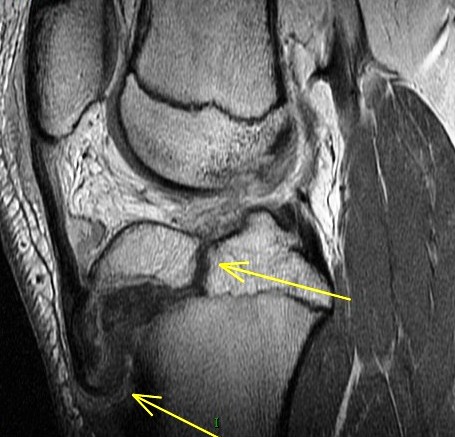 Figure 6 for case Salter type IV fracture ( RID4688 )